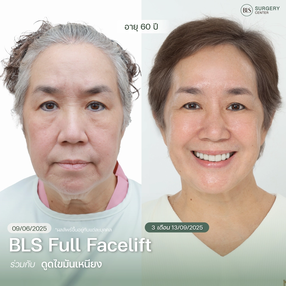 รวมรีวิวเคส Face Lift ยกกระชับหน้า ย้อนวัยเป็น 10 ปี โดยหมอเอิร์ธ
