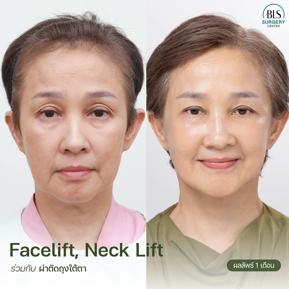 ชมเคสรีวิว ทำ Face lift ศัลยกรรมดึงหน้า ให้อ่อนเยาว์ ที่ BLS Surgery Center
