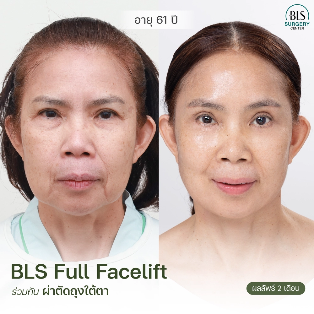 ชมเคสรีวิว ทำ Face lift ศัลยกรรมดึงหน้า ให้อ่อนเยาว์ ที่ BLS Surgery Center