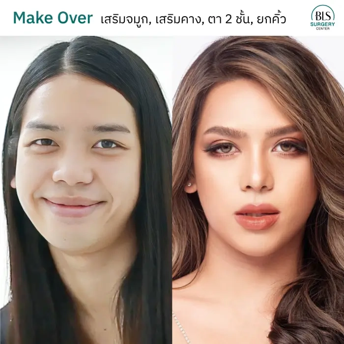 การยกคิ้วแบบทั่วไป เทคนิค Direct Brow Lift แผลเหนือคิ้ว
