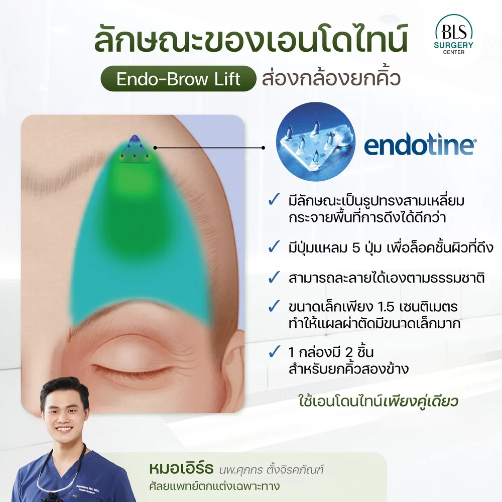ลักษณะของเอนโดไทน์ Endo-Brow Lift ส่องกล้องยกคิ้ว