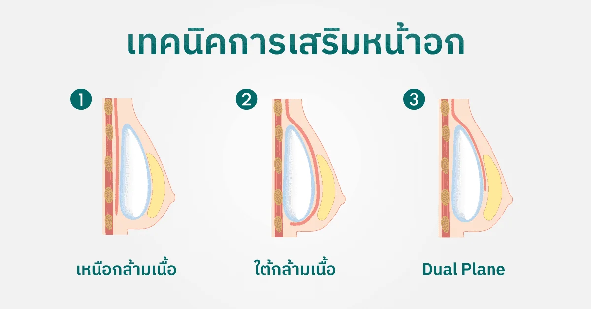 เทคนิคการเสริมหน้าอก (Breast Augmentation)