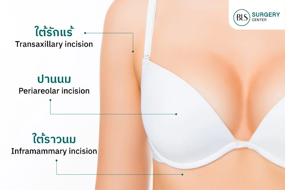 แผลผ่าตัดเสริมหน้าอกแต่ละตำแหน่ง มีข้อดี-ข้อเสียยังไง