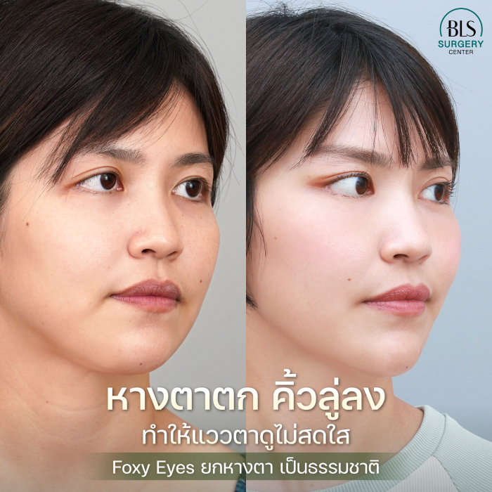 ปัญหาคิ้วและหางตาลู่ลง องศาไม่รับกับใบหน้า