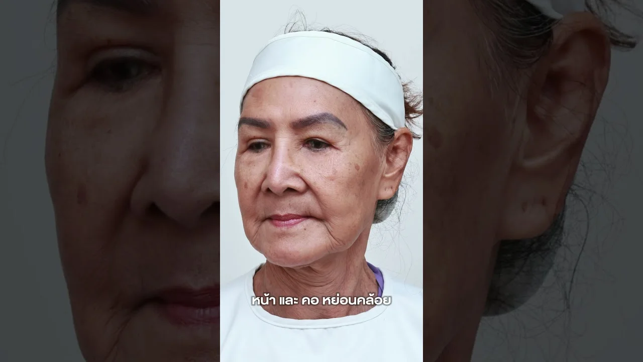 ชมวิดีโอ ศัลยกรรมผ่าตัดดึงหน้า เทคนิคซ่อนแผล ดีอย่างไร?