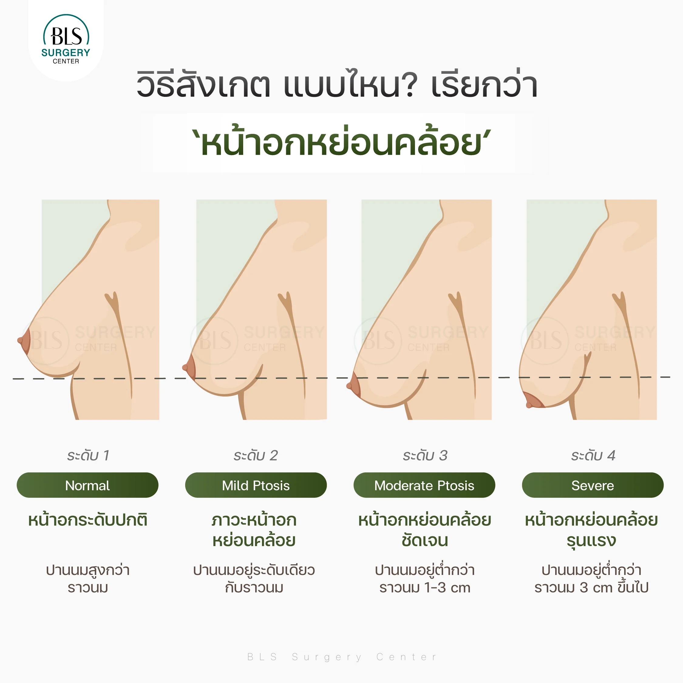 วิธีสังเกต แบบไหนเรียกว่าหน้าอกหย่อนคล้อย?
