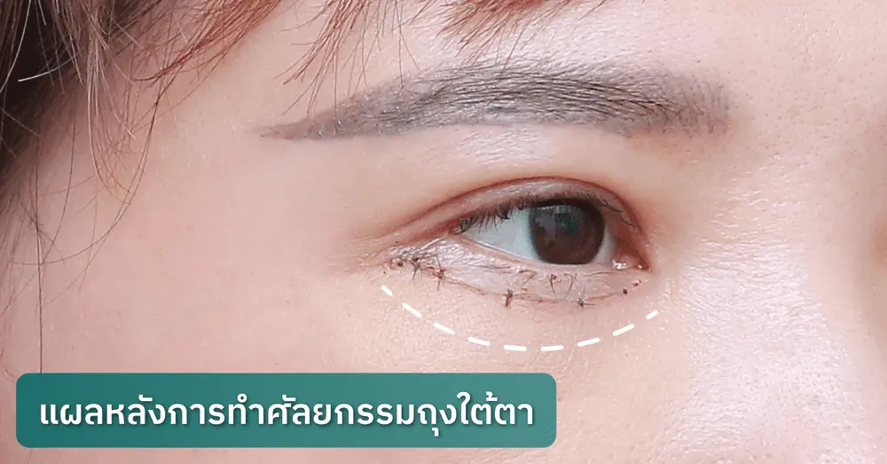 แผลหลังการทำศัลยกรรมถุงใต้ตา