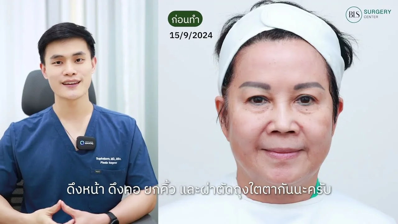 รวมเคสรีวิว Facelift หน้าสวย ผิวกระชับ ดูเด็กลง ที่ BLS Surgery Center