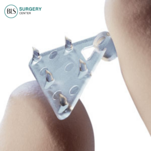 Endoscopic brow lift procedure – Endo-Brow Lift or Endotine brow lift