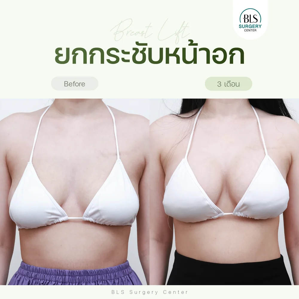ปัญหาหน้าอกหย่อนคล้อย หลังยกกระชับหน้าอก (Breast Lift หรือ Mastopexy) ช่วยให้หน้าอกยกขึ้น ดูเต่งตึงกระชับ ผลลัพธ์ดูเป็นธรรมชาติ