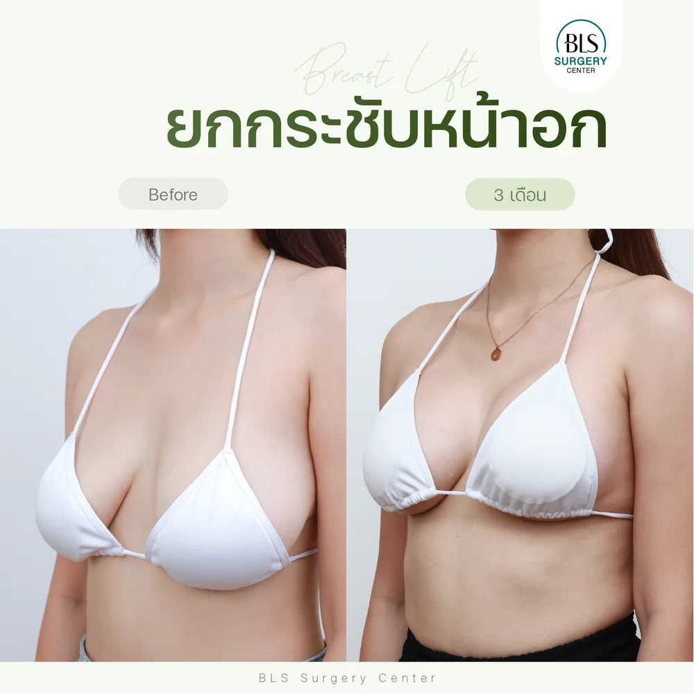 ปัญหาหน้าอกหย่อนยาน จนบราไม่สามารถพยุงหน้าอกขึ้นได้ ทำให้แต่งตัวยาก ออกกำลังกายลำบาก หลังแก้ด้วยเทคนิคยกกระชับหน้าอก (Breast Lift) ช่วยให้หน้าอกกลับมาเต่งตึง ใส่เสื้อผ้าง่าย ใช้ชีวิตสะดวกขึ้น
