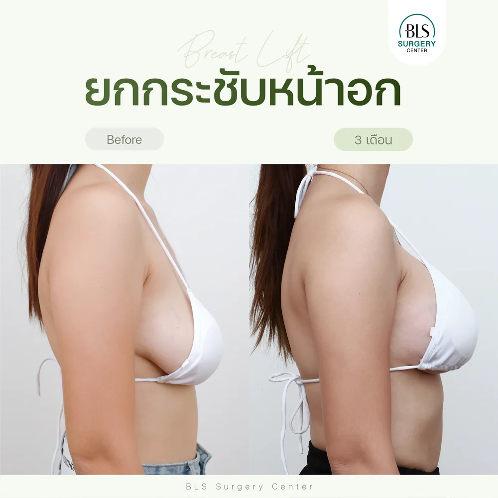 ปัญหาหน้าอกคล้อยจนมองเห็นจากภายนอกได้ชัดเจน หลังยกกระชับหน้าอก (Breast Lift) พร้อมกำจัดผิวที่หย่อนคล้อย ช่วยให้หน้าอกกระชับ ปรับระดับหน้าอกให้ยกขึ้น ตำแหน่งปานนมสูงขึ้น หน้าอกดูสวยงาม ได้สัดส่วนมากขึ้น