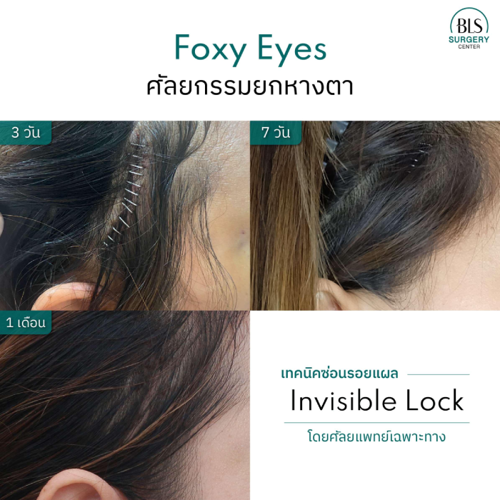 เปิด Timeline การหายของรอยแผลหลังทำ Foxy Eyes