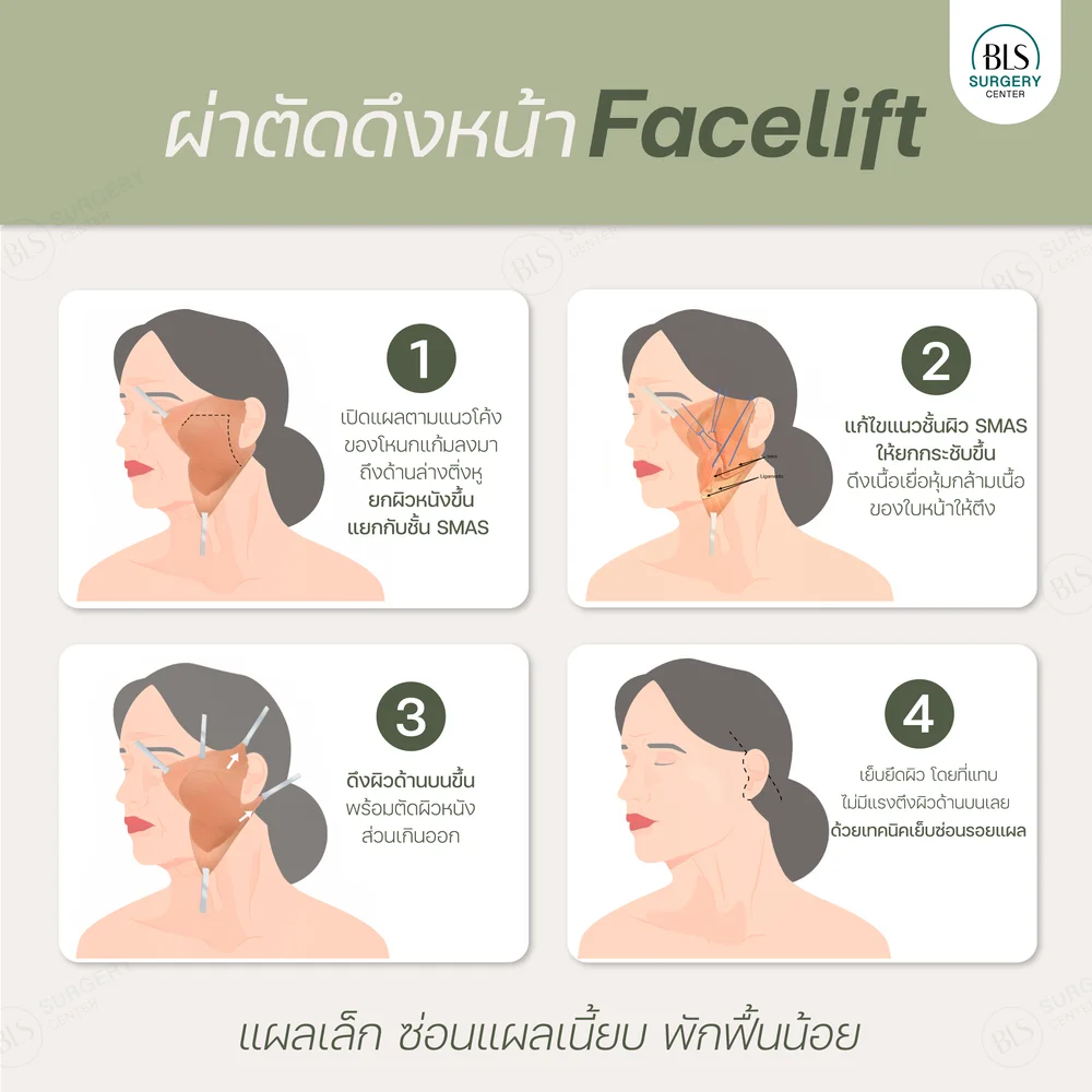 ผ่าตัดดึงหน้า Facelift