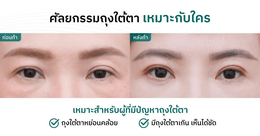 ศัลยกรรมผ่าตัดถุงใต้ตา เหมาะกับใคร?