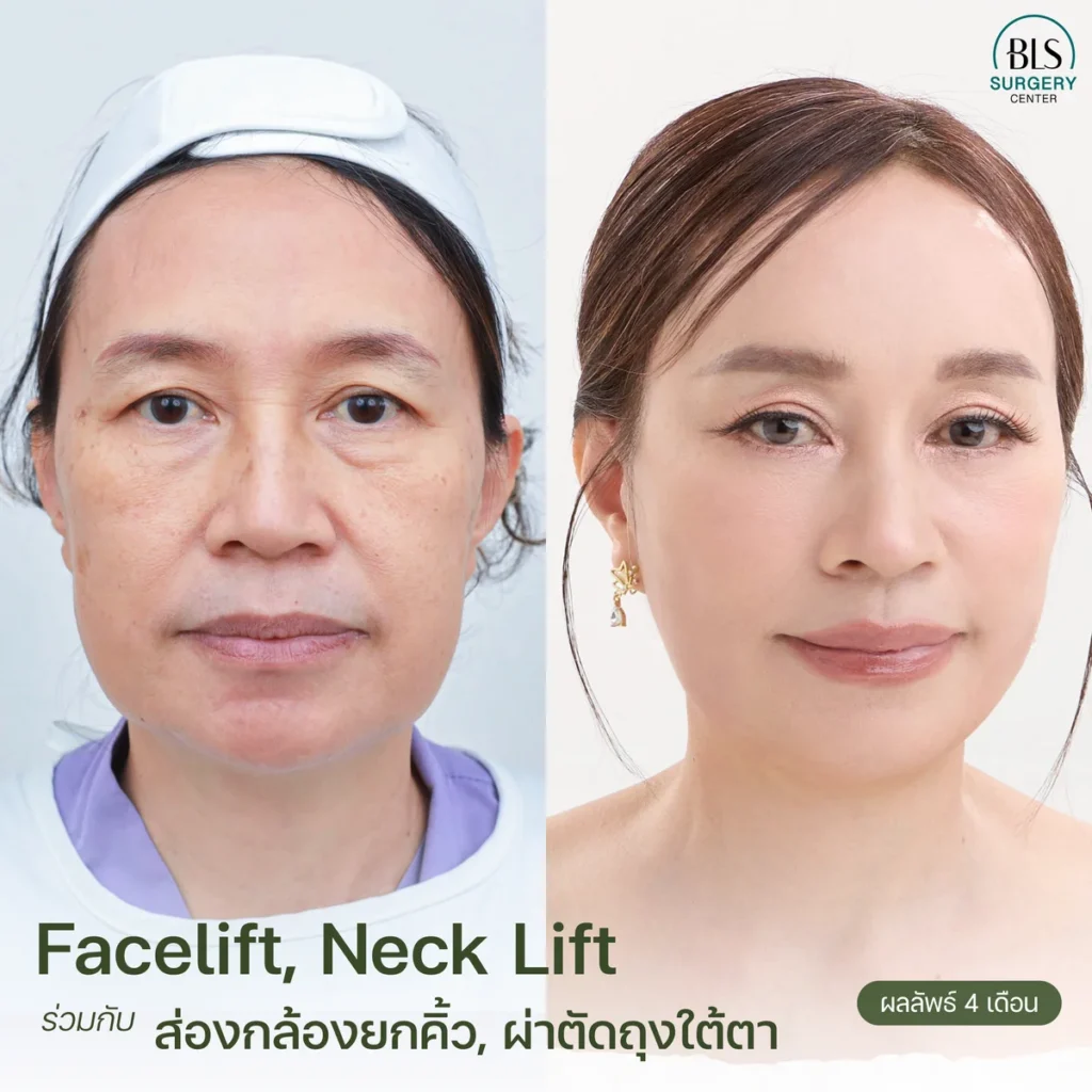 รีวิวดึงหน้า (Face Lift) ยกคิ้วส่องกล้อง (Endo-Brow Lift) ดึงหน้าส่องกล้อง (Endotine midface) ที่ BLS Surgery Center