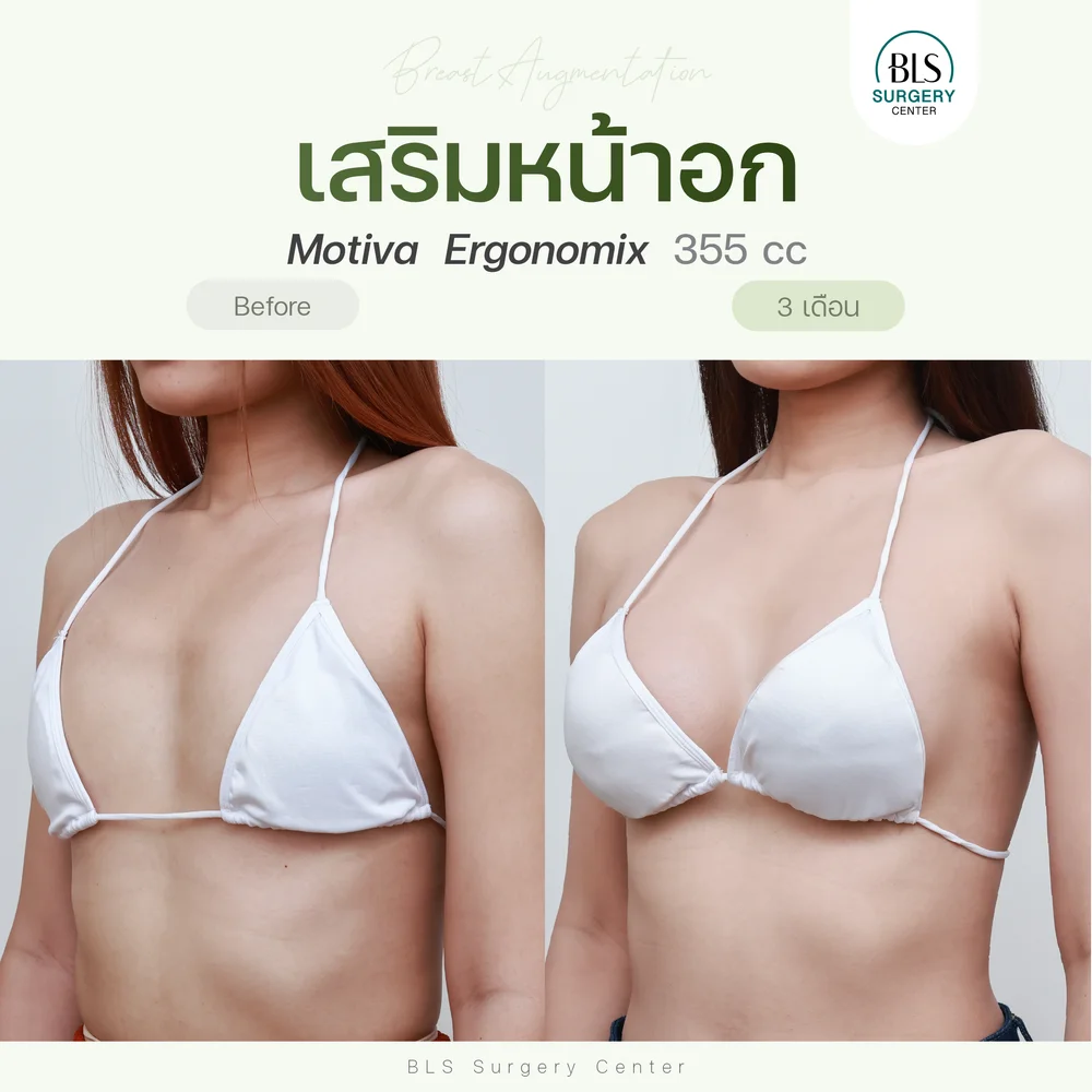 ปัญหาก่อนทำ ปัญหาก่อนทำ หน้าอกแบน รูปร่างดูไม่ได้สัดส่วน หลังเสริมหน้าอกซิลิโคน Motiva Ergonomix 355 cc ช่วยเพิ่มขนาดทรวงอก หน้าอกดูอิ่มเอิบ ลุคคุณหนู พร้อมรูปร่างที่ดูดี มีสัดส่วนที่ดีขึ้นอย่างเป็นธรรมชาติ