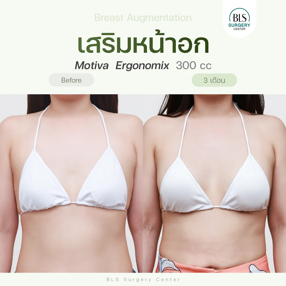ปัญหาก่อนทำ เนื้อหน้าอกน้อย ดูอกแบน แต่งตัวยาก หลังเสริมหน้าอก ซิลิโคน Motiva Ergonomix 300 cc ช่วยให้มีเนินอกสวยๆ ทรงคุณหนู ดูละมุนและเป็นธรรมชาติ