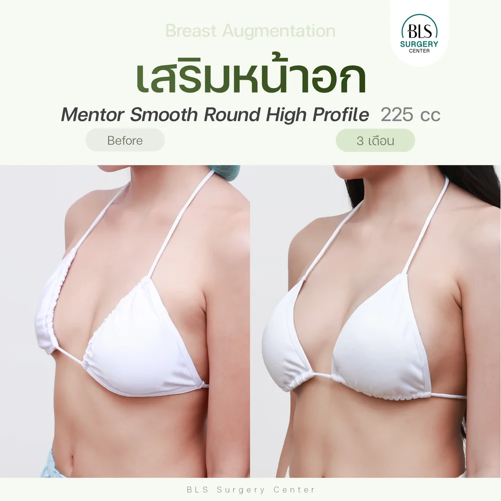 ปัญหาก่อนทำ หน้าอกเล็ก และเริ่มมีความหย่อนคล้อยหลังเสริมหน้าอกซิลิโคน Mentor High Smooth Round Profile 225 cc ช่วยเพิ่มขนาดหน้าอก รูปร่างได้สัดส่วนมากขึ้น หน้าอกทรงสวย ผลลัพธ์เป็นธรรมชาติ
