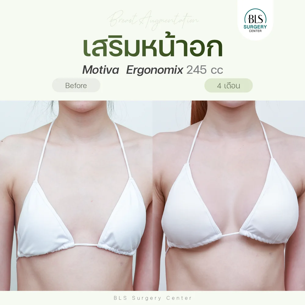 ปัญหาก่อนทำ รูปร่างเล็ก ทำให้หน้าอกเล็กตามไปด้วย หลังเสริมหน้าอกซิลิโคน Motiva Ergonomix 245 cc ทำให้รูปร่างสมส่วน ดูดีมากขึ้น ทรงหน้าอกสวยดูธรรมชาติ