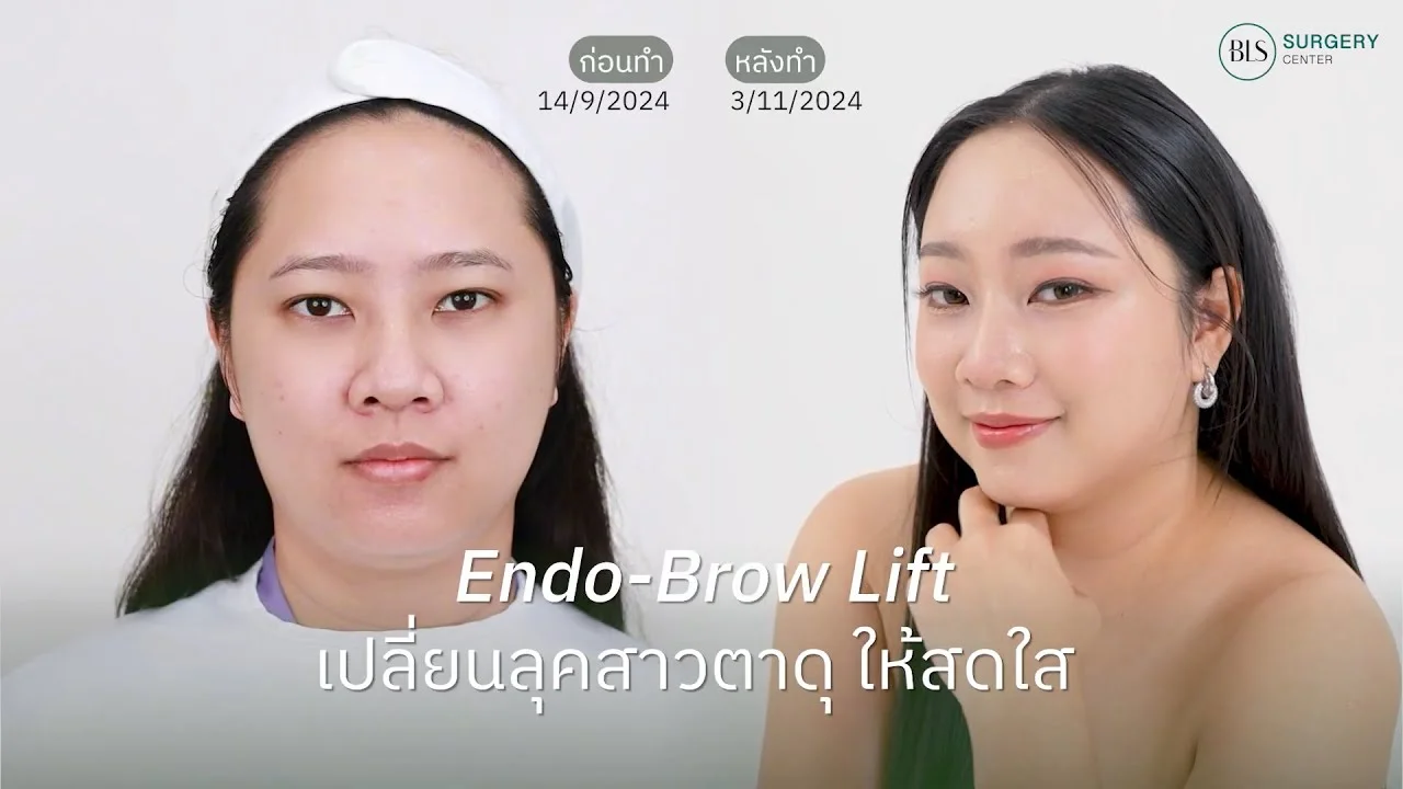 Endo-Brow Lift ส่องกล้องยกคิ้ว เปลี่ยนลุคสาวตาดุ ให้สดใส