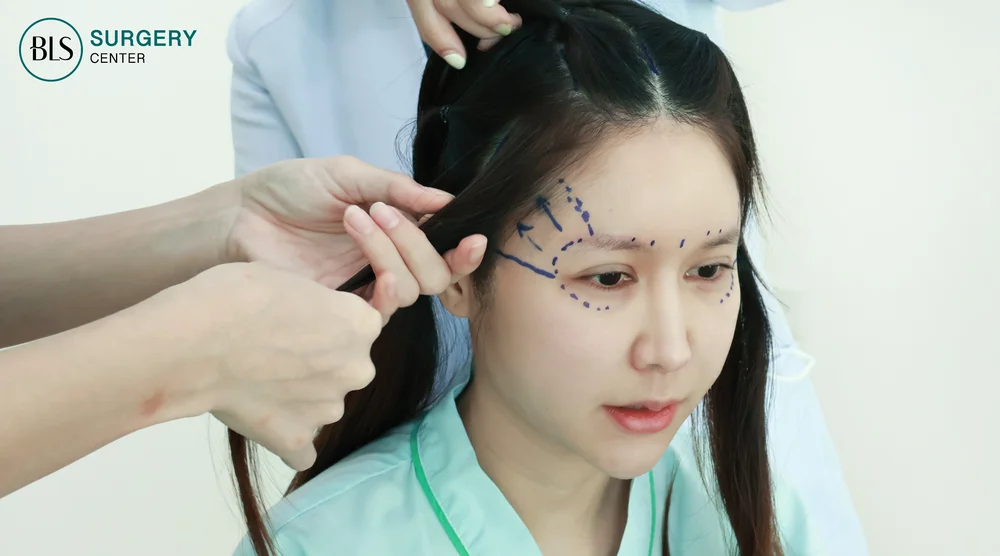 ขั้นตอนการทำ Endobrow Lift