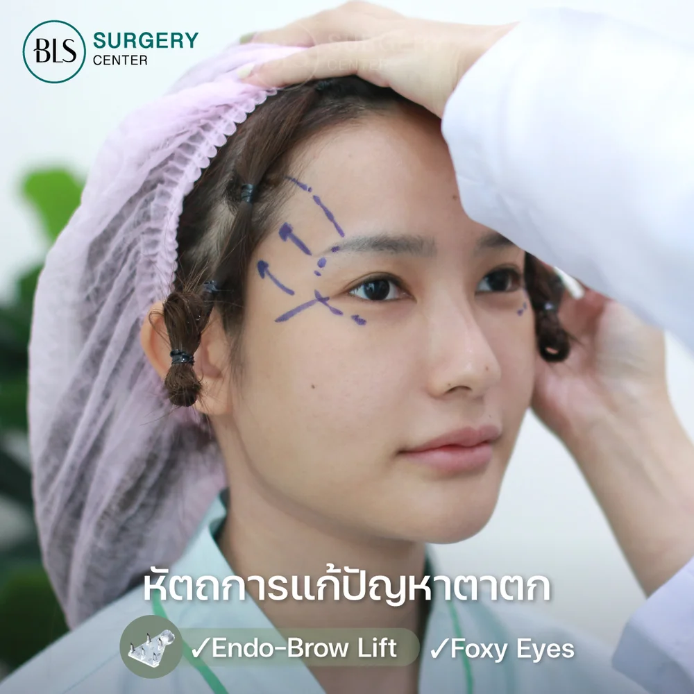 Foxy Eyes ร้อยไหม ยกหางตา