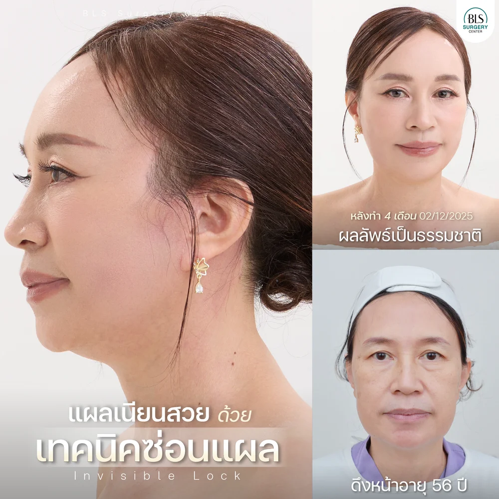 การดูแลตัวเองหลังผ่าตัดดึงหน้า | ยกกระชับใบหน้า Face lift