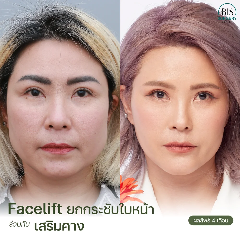 ปัญหาหนังตาและหางตาตก