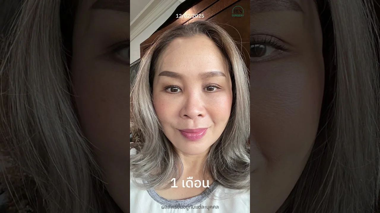 เปิดไทม์ไลน์แบบเรียล ๆ หลังทำ 'ดึงหน้าย้อนวัย' สวยสดใส ใบหน้าอ่อนกว่าวัยอย่างเป็นธรรมชาติ