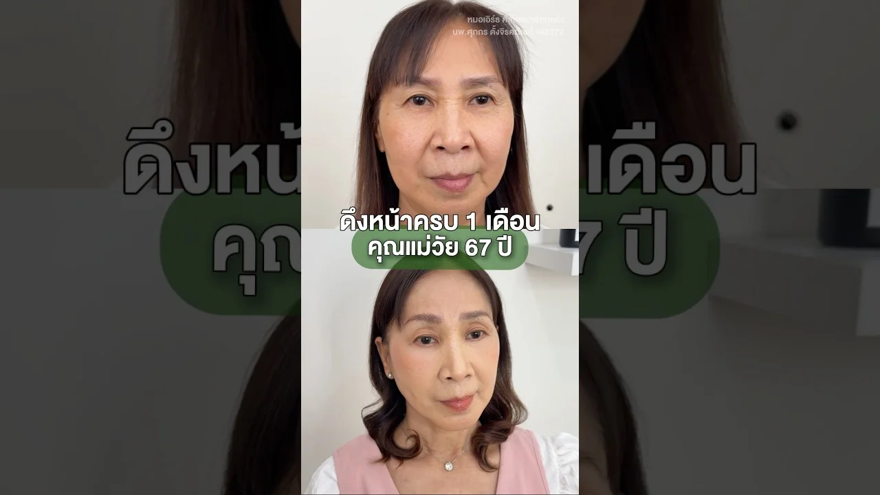 ผลลัพธ์ 1 เดือน หลังดึงหน้าในวัย 67 ปี!