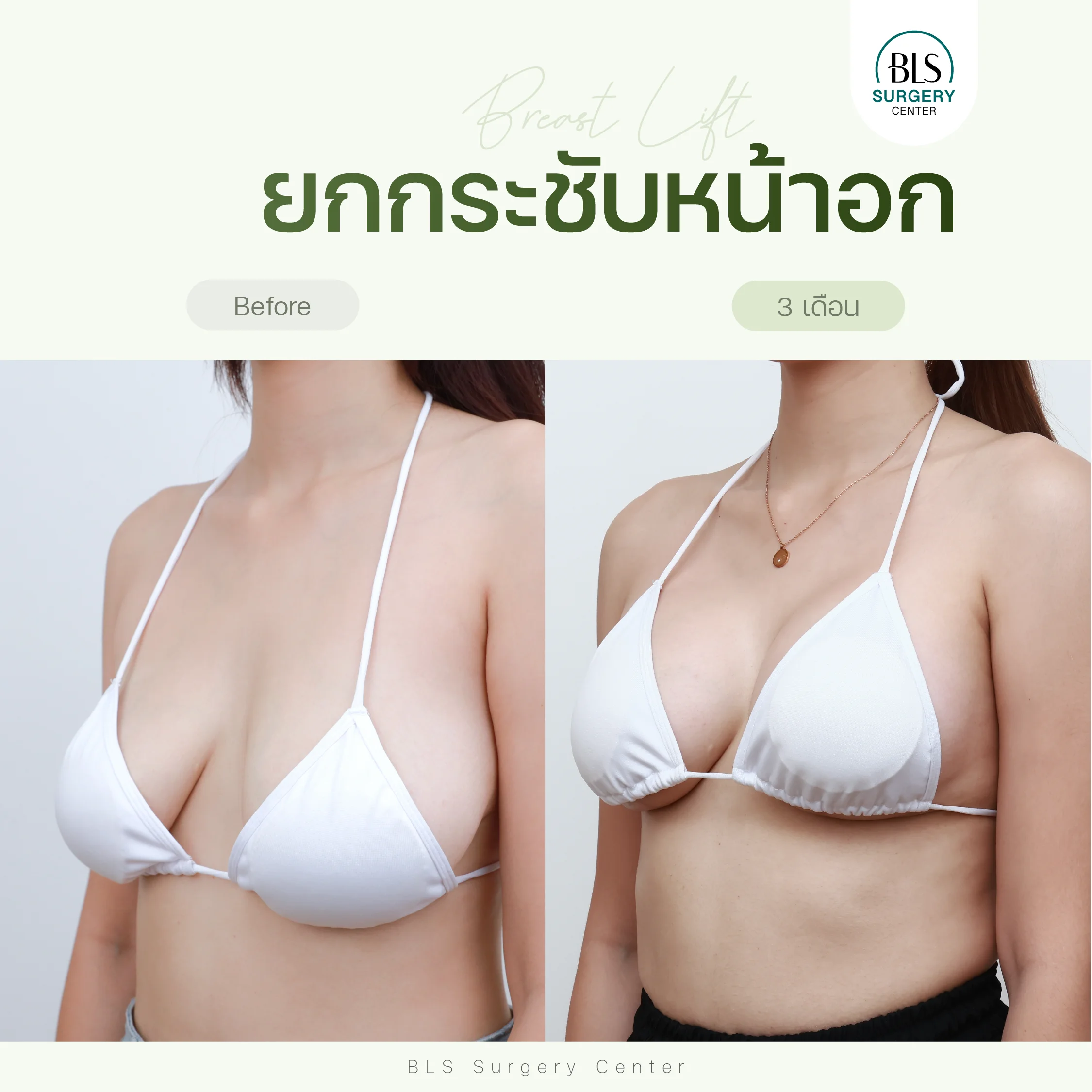 รีวิวยกกระชับหน้าอก (Breast Lift หรือ Mastopexy) | ศัลยกรรมหน้าอก