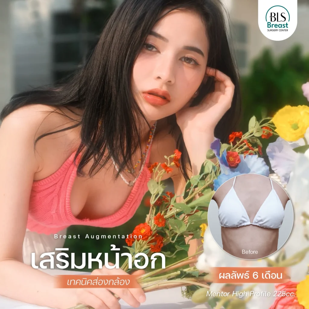 รีวิว ศัลยกรรมหน้าอก อกสวยธรรมชาติ ทรงละมุน ที่ BLS Surgery Center