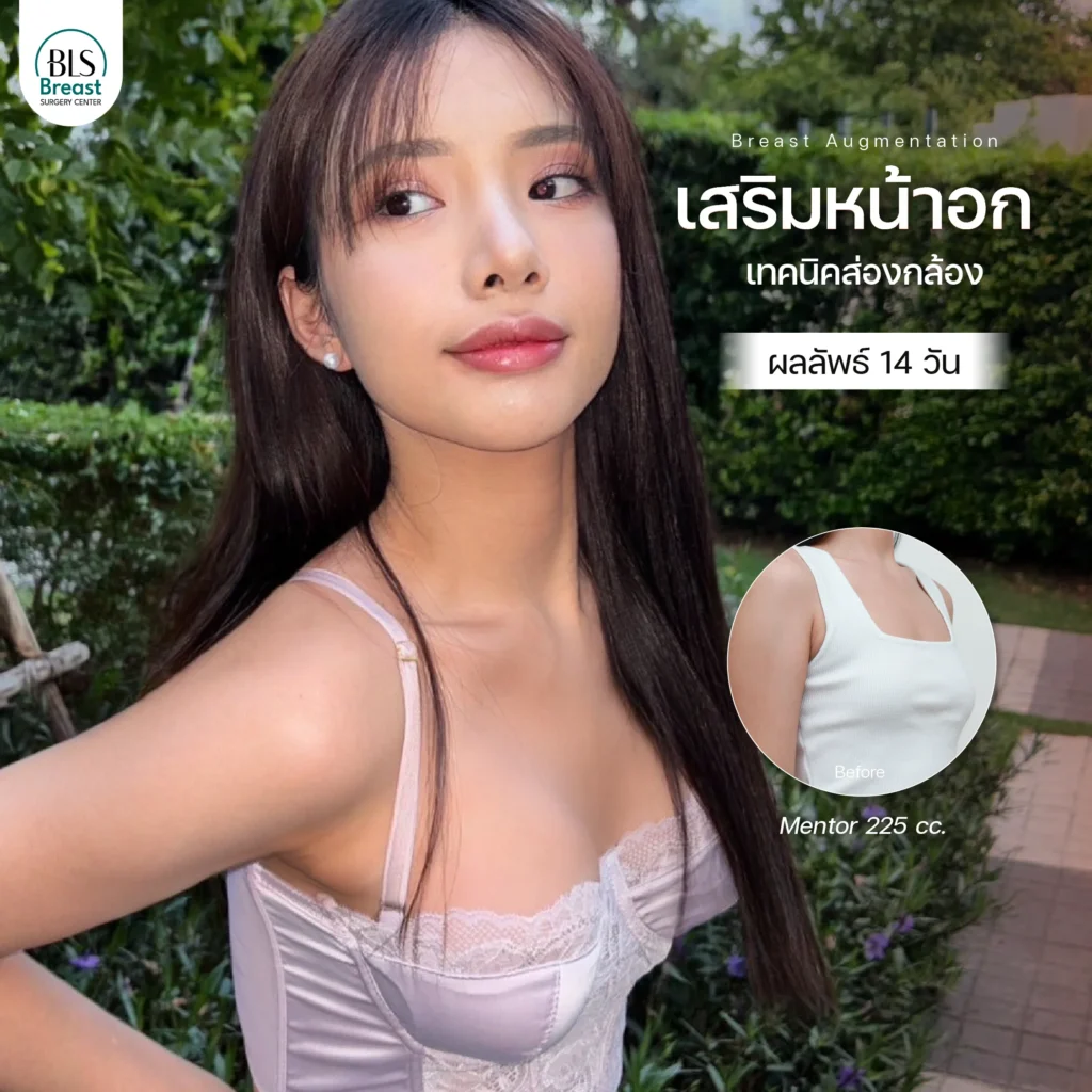 รีวิว ศัลยกรรมหน้าอก อกสวยธรรมชาติ ทรงละมุน ที่ BLS Surgery Center