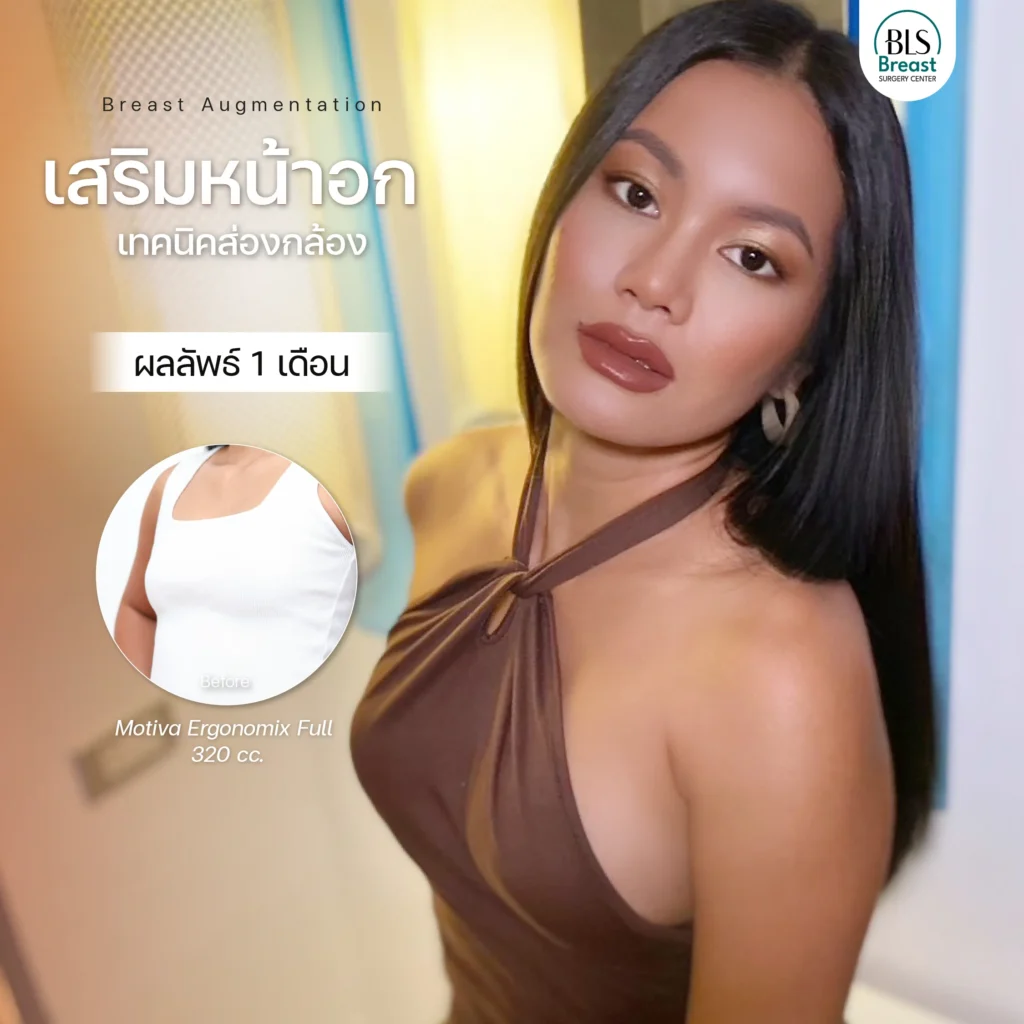 รีวิว ศัลยกรรมหน้าอก อกสวยธรรมชาติ ทรงละมุน ที่ BLS Surgery Center