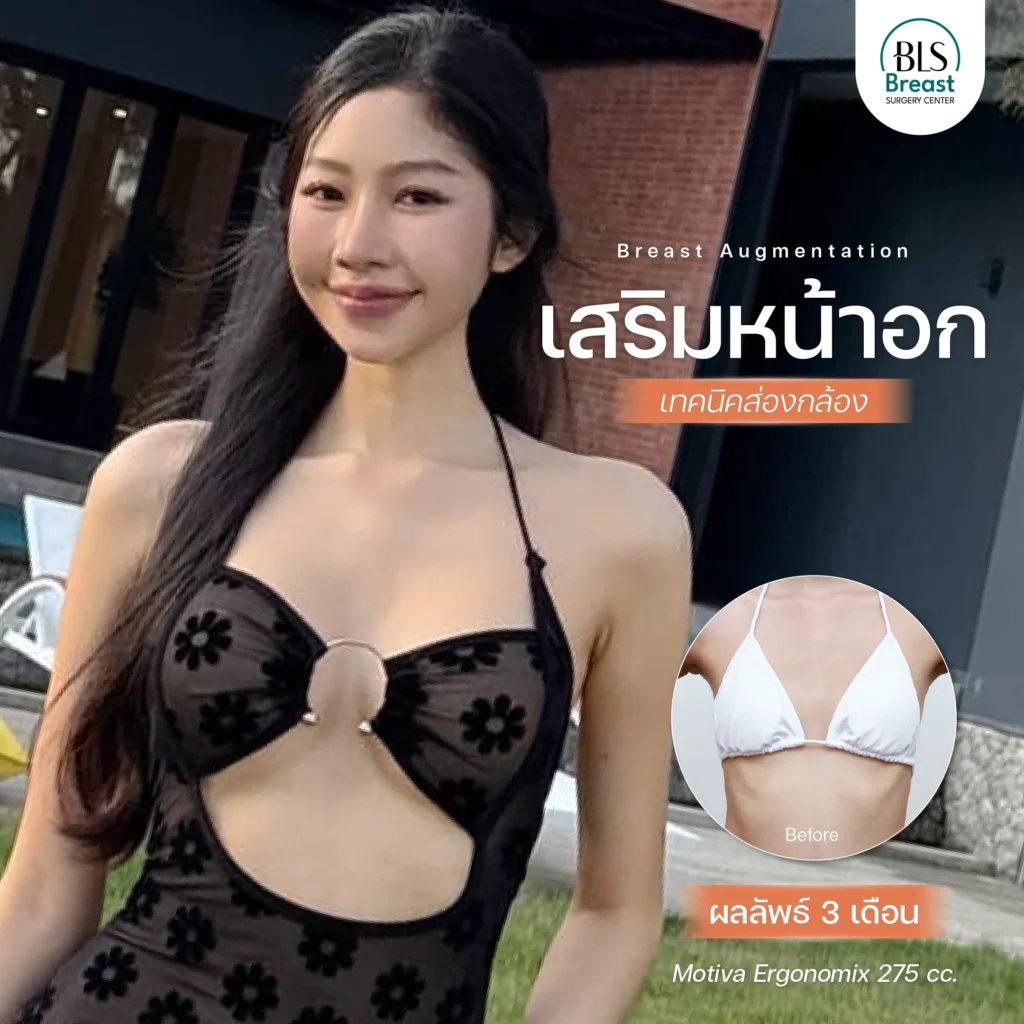 รีวิว ศัลยกรรมหน้าอก อกสวยธรรมชาติ ทรงละมุน ที่ BLS Surgery Center