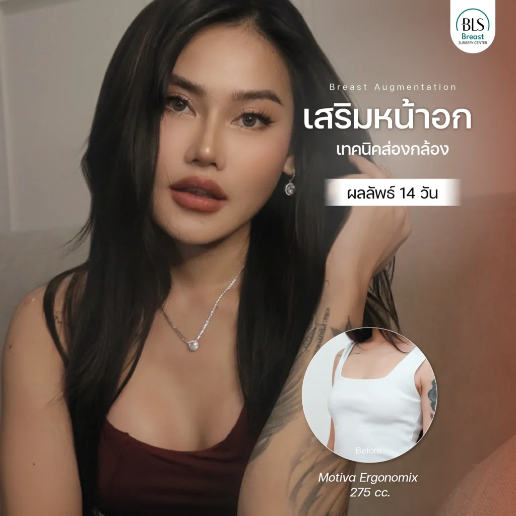 รีวิว ศัลยกรรมหน้าอก อกสวยธรรมชาติ ทรงละมุน ที่ BLS Surgery Center