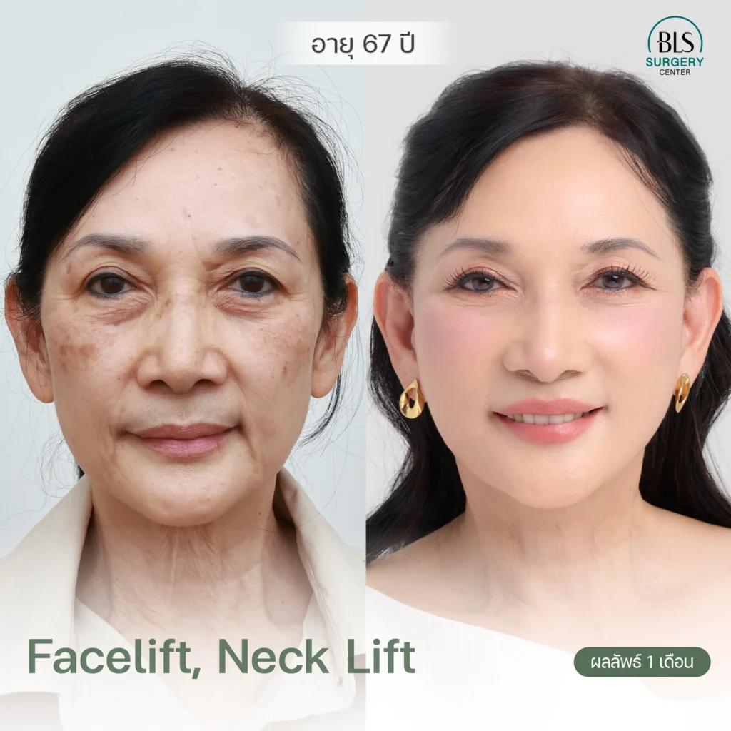 ชมผลงานหมอเอิร์ธ ดึงหน้าตึง รีวิวสวยๆ ที่ BLS Surgery Center