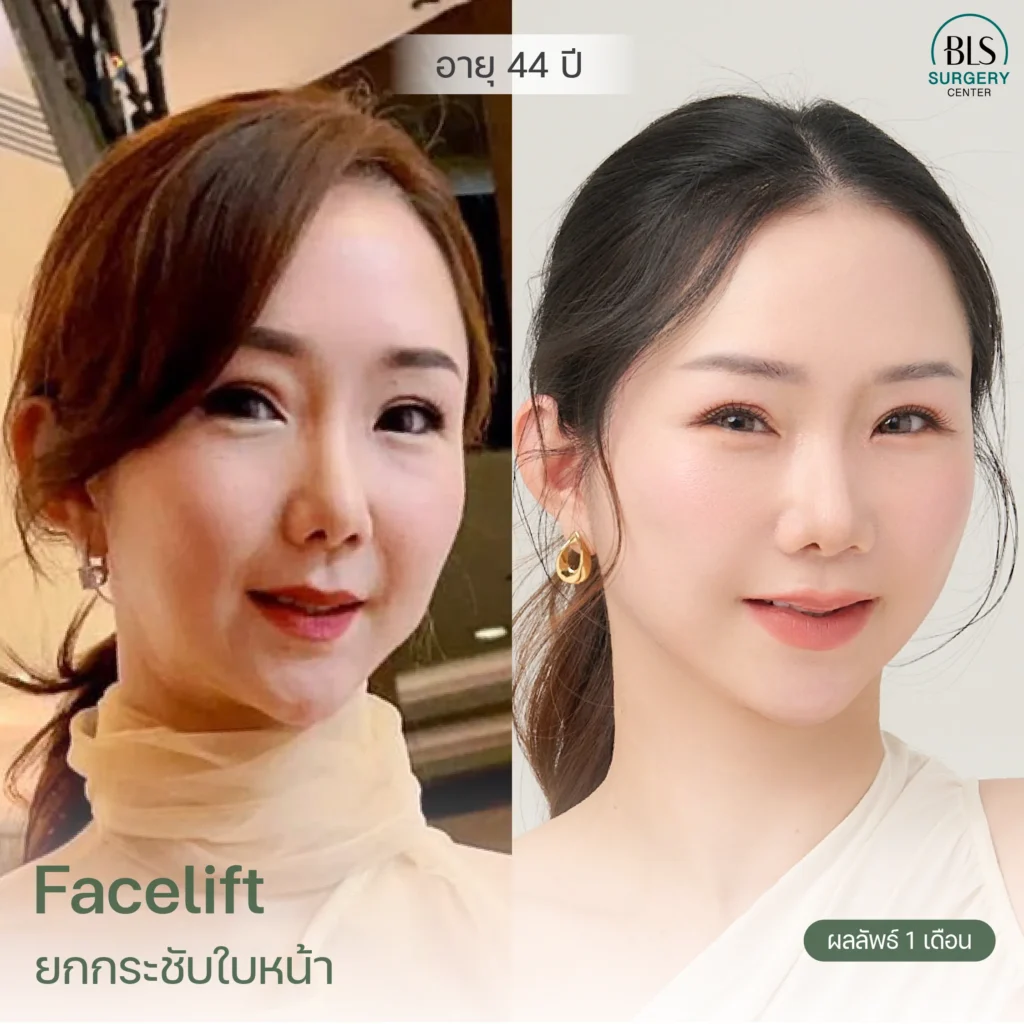 ชมผลงานหมอเอิร์ธ ดึงหน้าตึง รีวิวสวยๆ ที่ BLS Surgery Center