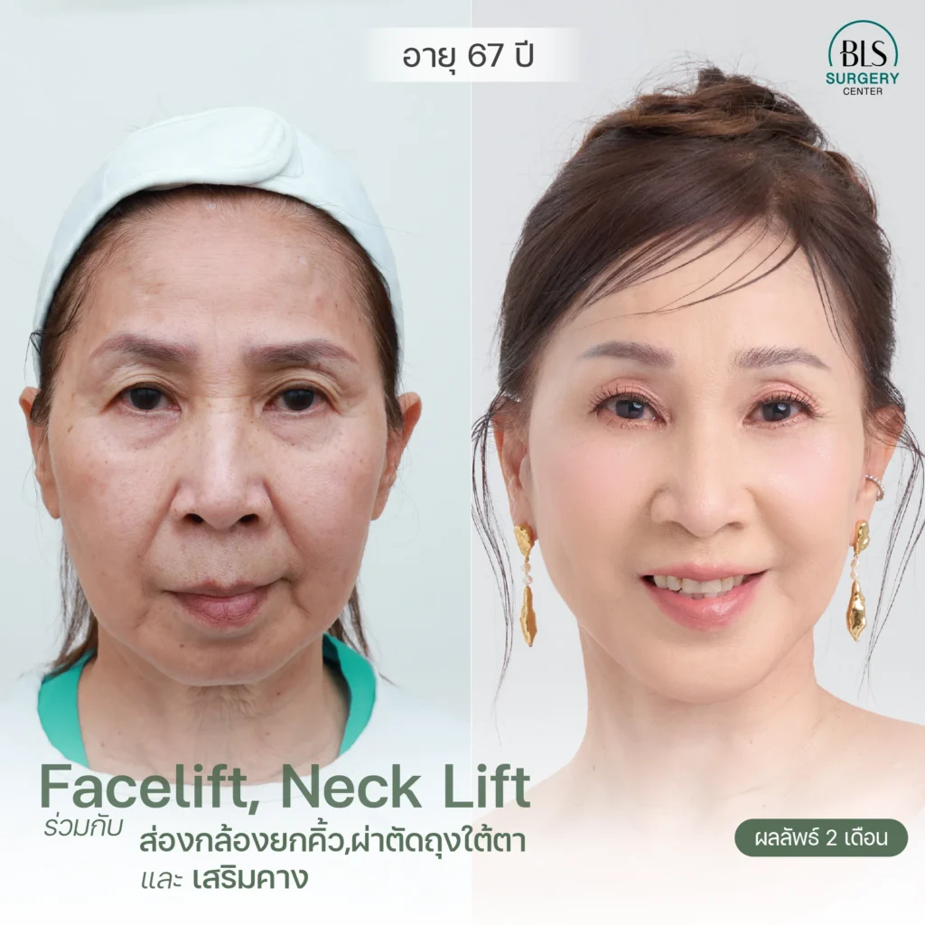 ชมผลงานหมอเอิร์ธ ดึงหน้าตึง รีวิวสวยๆ ที่ BLS Surgery Center