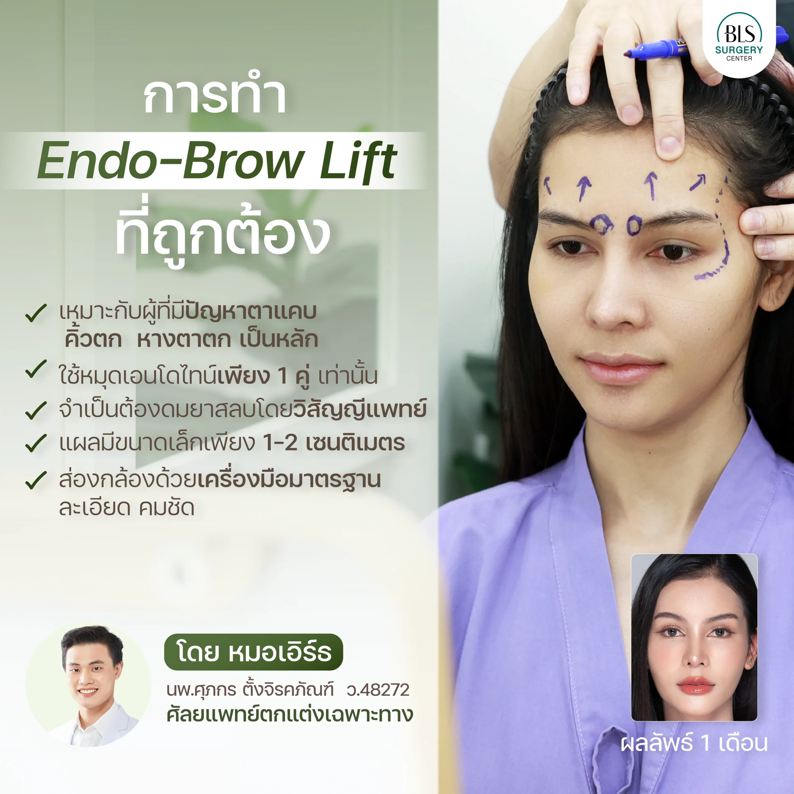 Endoscopic Brow Lift โดย หมอเอิร์ธ ดึงหน้า