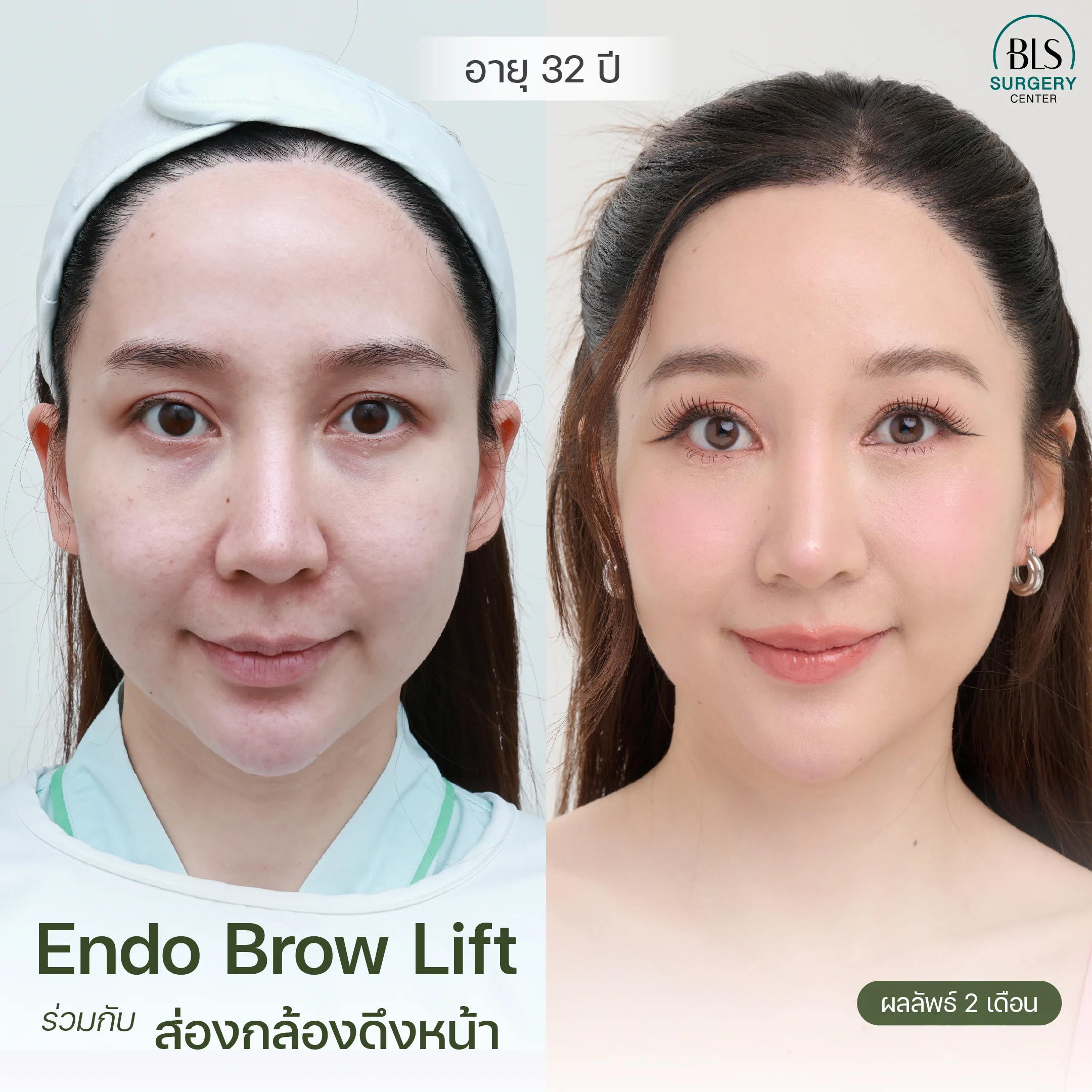 ผลลัพธ์ Endotine Facelift กรอบหน้าชัด หน้าเด็ก เป็นธรรมชาติ | ส่องกล้องดึงหน้า