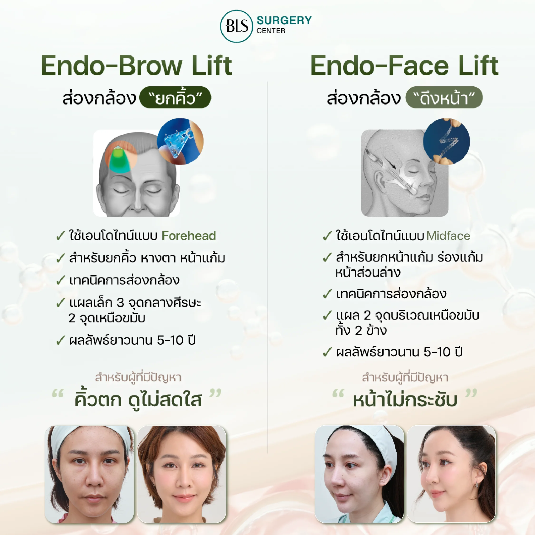 ยกกระชับหน้า Endotine Facelift Endoscopic Brow Lift ต่างกันอย่างไร