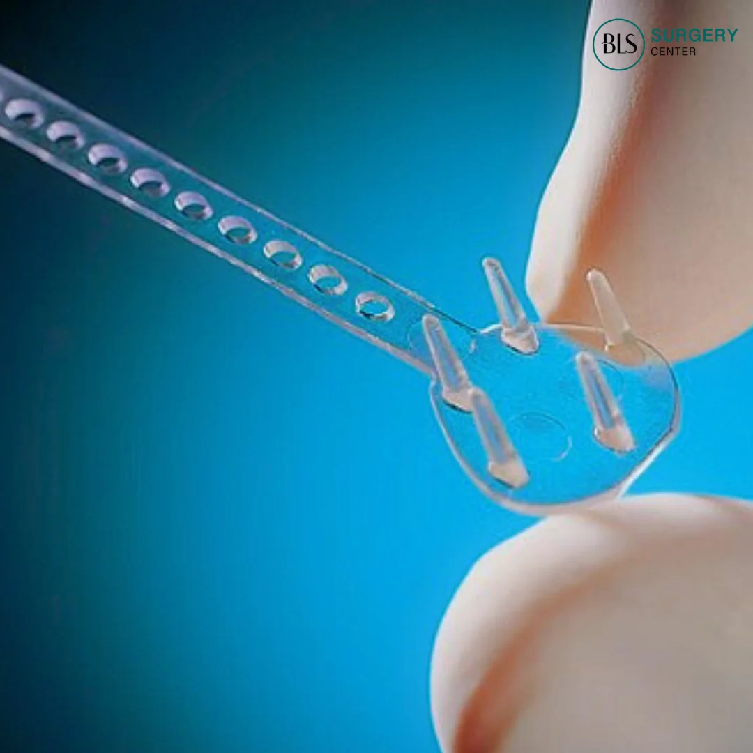 ดึงหน้า Endotine ดึงหน้าแผลเล็ก