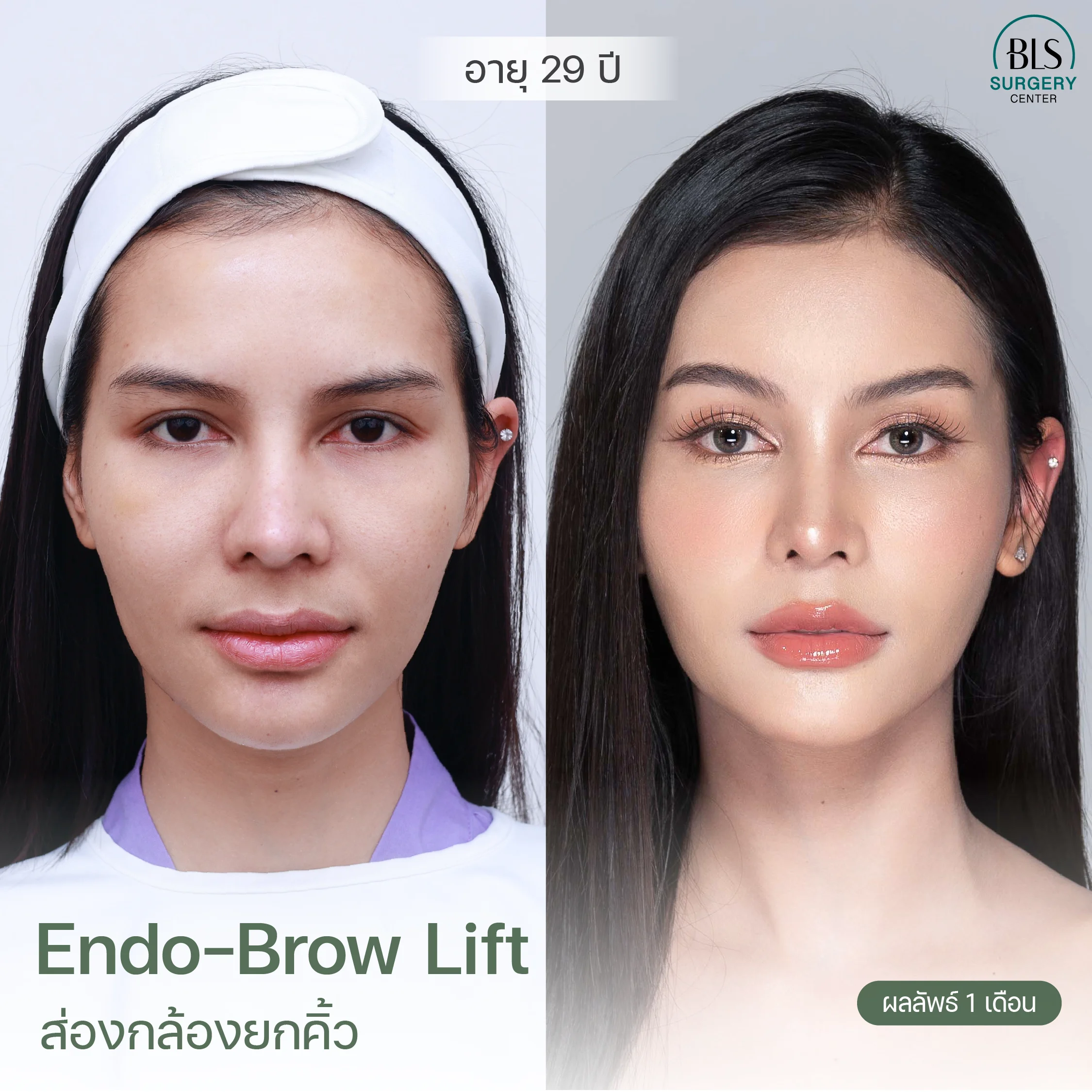 ยกคิ้วหน้าเด็ก ส่องกล้องยกคิ้ว แก้คิ้วตก หนังตาตก