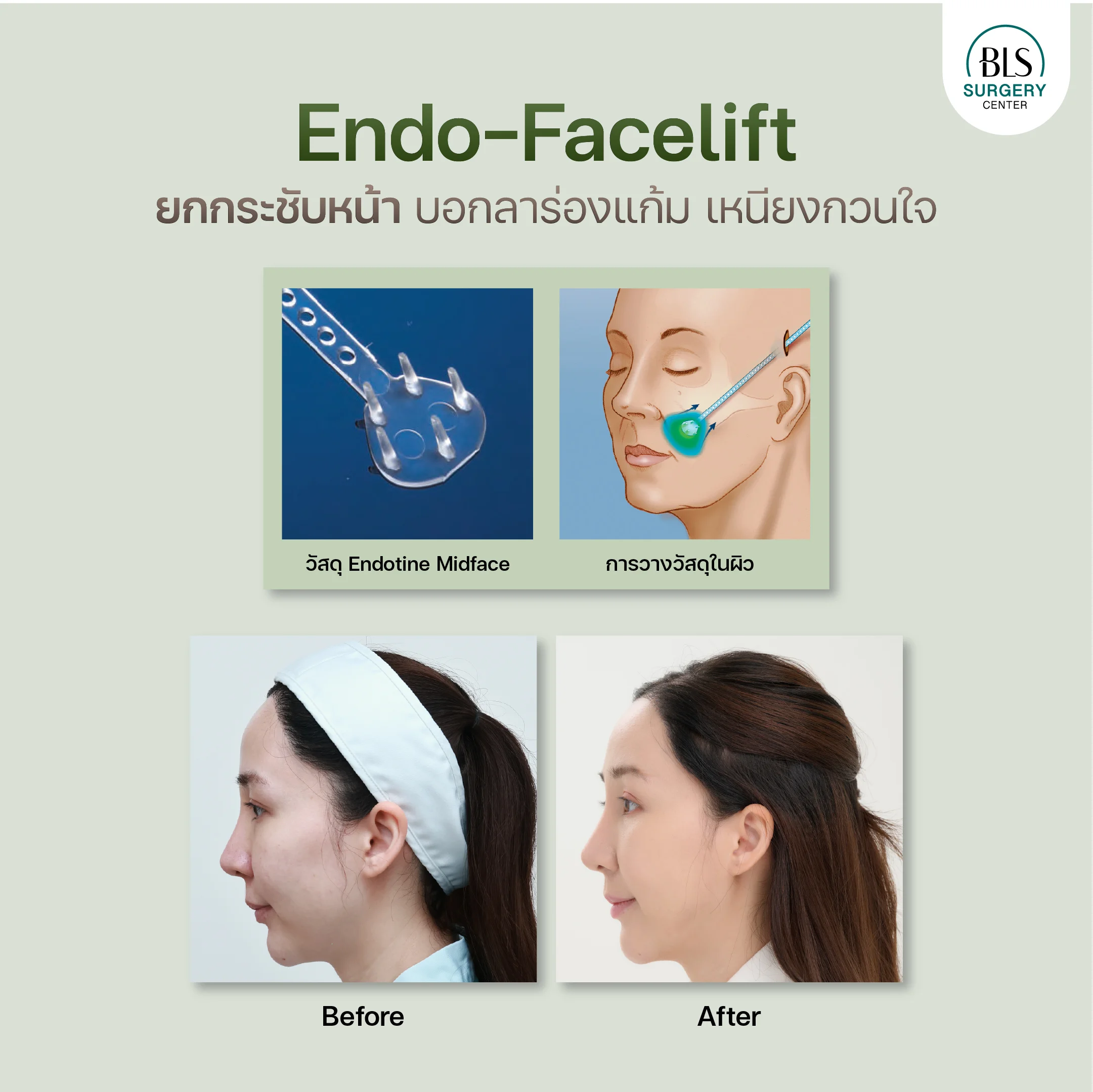 ยกกระชับหน้า แก้ปัญหา ร่องแก้ม เหนียงคอ