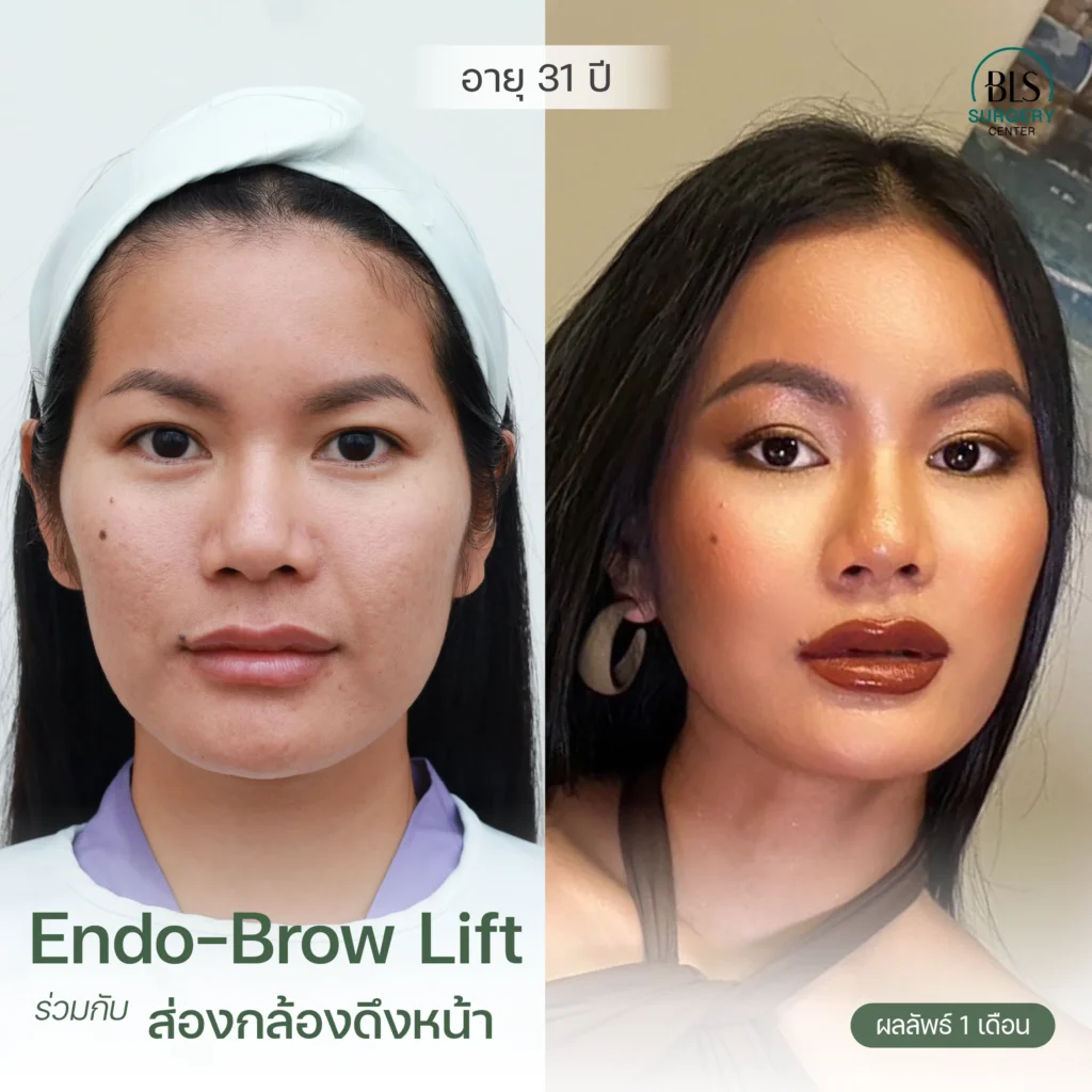 รีวิวผลงานของหมอเอิร์ธ ดึงหน้า ที่ BLS Surgery Center | ส่องกล้องดึงหน้า