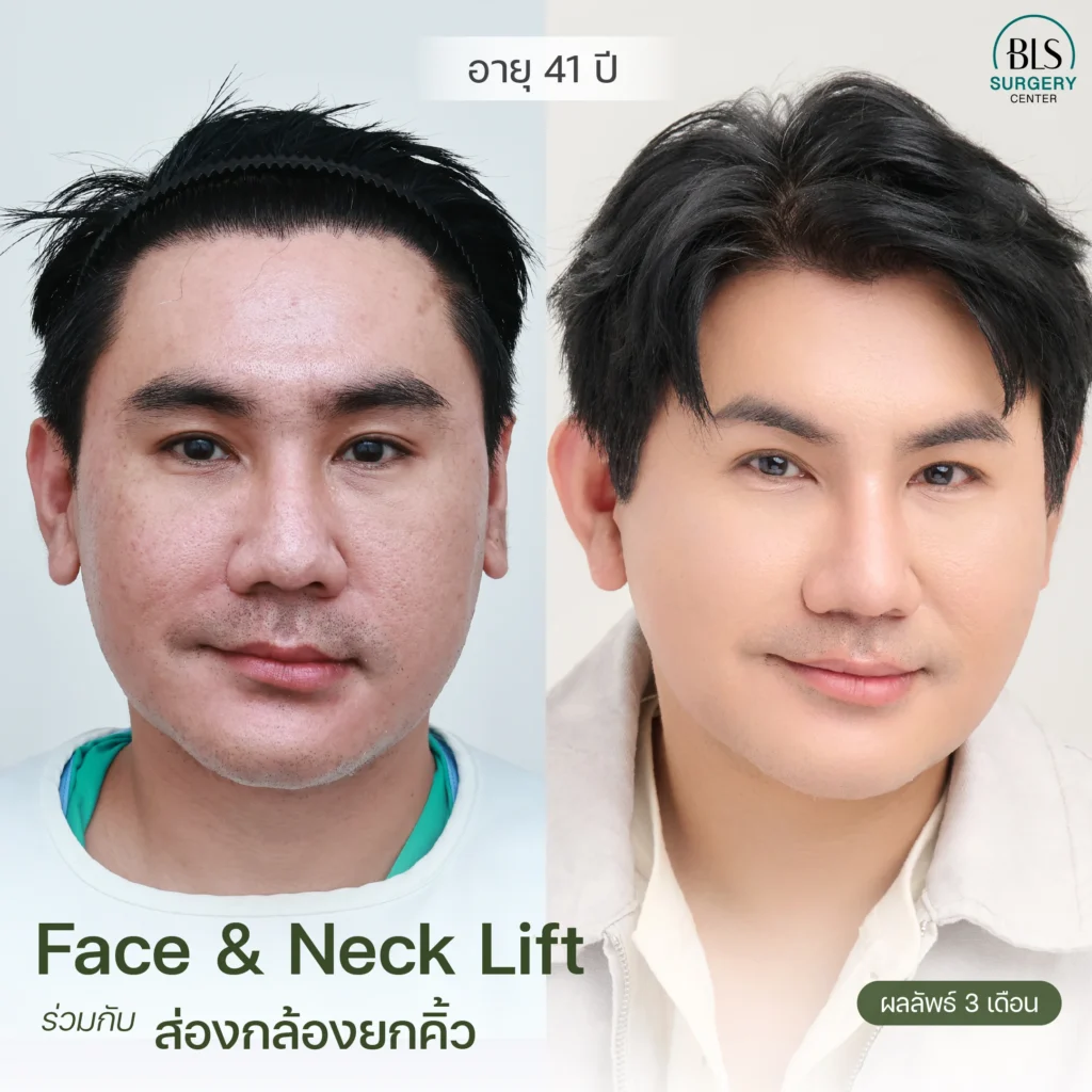 รีวิวผลงานของหมอเอิร์ธ ดึงหน้า ที่ BLS Surgery Center