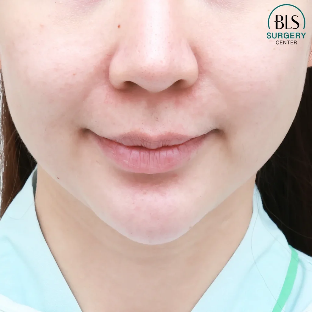 ดึงหน้าตึง ยกกระชับหน้า | ส่องกล้องดึงหน้า