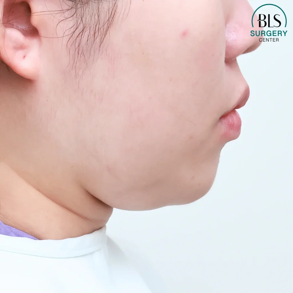 ดึงหน้าตึง ยกกระชับหน้า | ส่องกล้องดึงหน้า